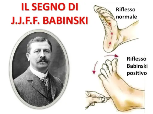 Ritratto di J.J.F. Babinski, con illustrazioni del riflesso normale e del riflesso di Babinski positivo.