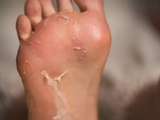 Piedi con pelle che si sfalda, possibili piaghe da sudore.