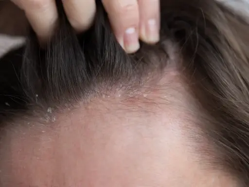 Dettaglio del cuoio capelluto con squame biancastre e arrossamento, indicativo di dermatite atopica.