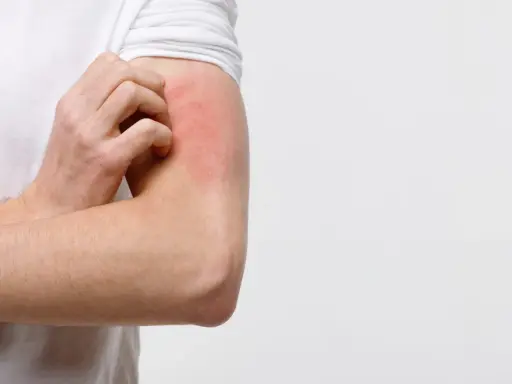 Braccio con arrossamento e prurito, possibile eczema diabetico.