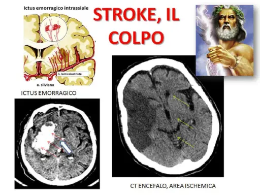 Immagini mediche mostrano ictus cerebrali, emorragici e ischemici. La vasculopatia cerebrale cronica può influenzare l'aspettativa di vita.