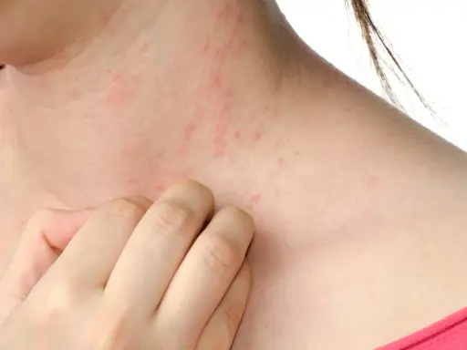 Pelle arrossata e irritata sul collo, con piccole pustole rosse. Una mano si gratta, sintomo di sudore e prurito.
