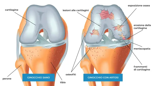 Confronto tra ginocchio sano e ginocchio con artrosi: lesioni, erosione cartilagine, osteofiti e frammenti evidenziano il progredire dell'artrosi.