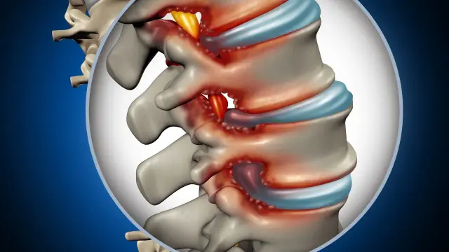 Ingrandimento della colonna vertebrale lombare che mostra la stenosi lombare, con compressione dei nervi spinali.