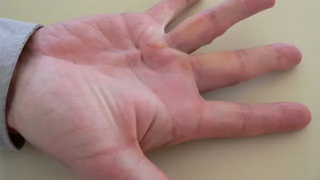 Mano con noduli e ispessimenti palmari, segni del morbo di Dupuytren che limitano l'estensione delle dita.