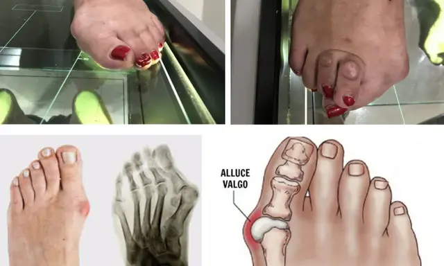 Immagini di piedi con alluce valgo, radiografie e un'illustrazione anatomica. Il dottore dei piedi, l'ortopedico, studia queste condizioni.