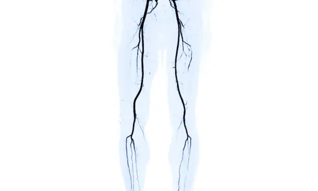 Angiografia delle gambe che mostra l'arteria femorale ostruita, un sintomo di problemi circolatori.