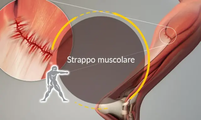 Illustrazione anatomica di uno strappo muscolare, con ingrandimento che mostra la sutura di una lesione muscolare.
