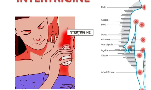 Intertrigine sotto il seno: rimedi della nonna per il rossore. Illustrazione mostra zone colpite da intertrigine.