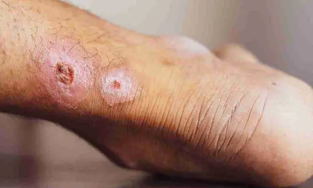 Pelle del piede con lesioni infiammate, arrossate e crostose, che suggeriscono un forte dolore alla pelle al tatto.