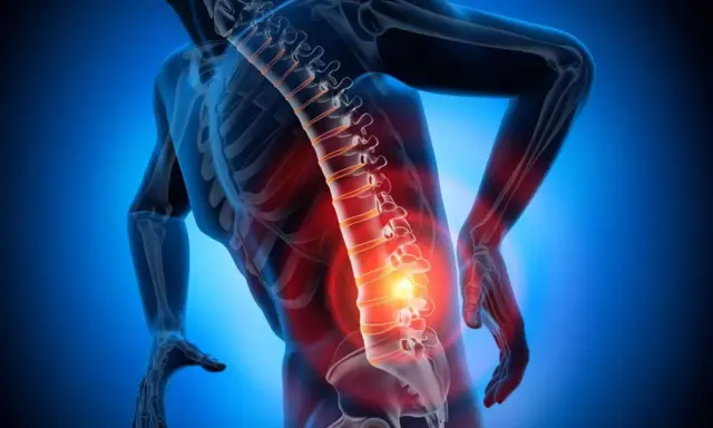 Schiena umana con colonna vertebrale evidenziata in rosso, indicando dolore e possibili ernia lombare con sintomi neurologici.