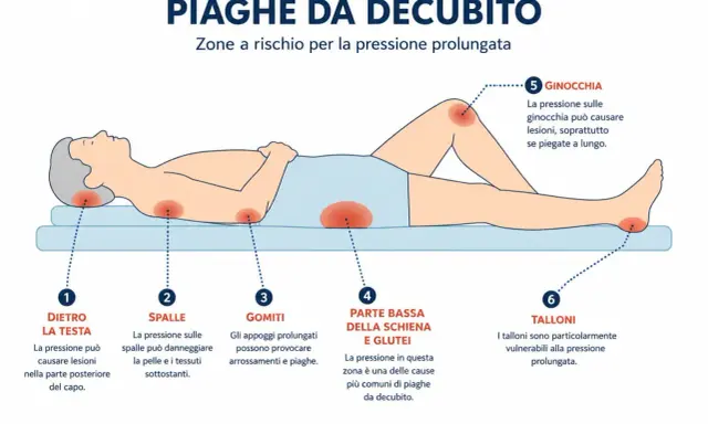 Illustrazione mostra le zone a rischio di piaghe da decubito: testa, spalle, gomiti, schiena, glutei, ginocchia e talloni. Prevenire è il primo passo per curare le piaghe.
