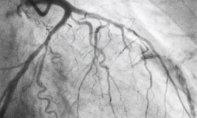 Immagine radiografica del cuore, mostrando le arterie coronarie dopo una coronarografia. Un passo importante nella convalescenza.