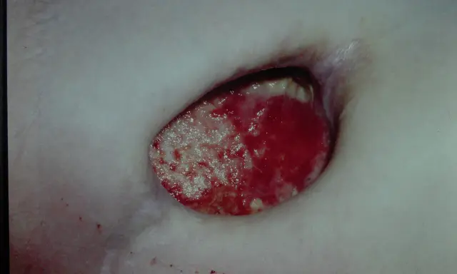 Piaga da decubito sacrale con tessuto necrotico e granulazione. Guida su come curare piaghe da decubito sacrali.