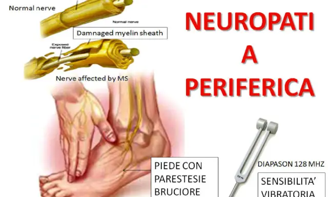 Illustrazione di neuropatia periferica con sintomi come parestesie e bruciore al piede, e diapason per testare la sensibilità vibratoria.