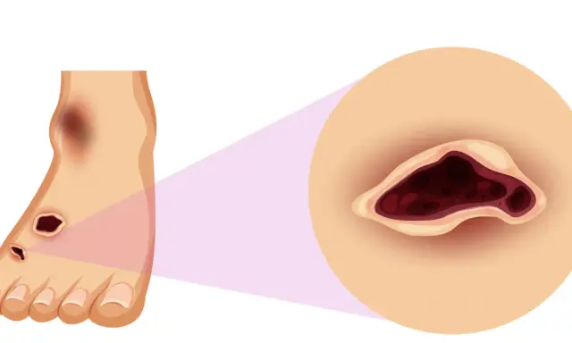 Ingrandimento di un piede con lesioni scure e profonde, che evidenzia la necessità di chi cura i piedi per trattare queste ferite.