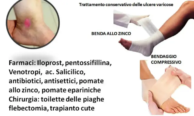 Trattamento conservativo per ulcere venose: bendaggio allo zinco e compressivo, farmaci e chirurgia.