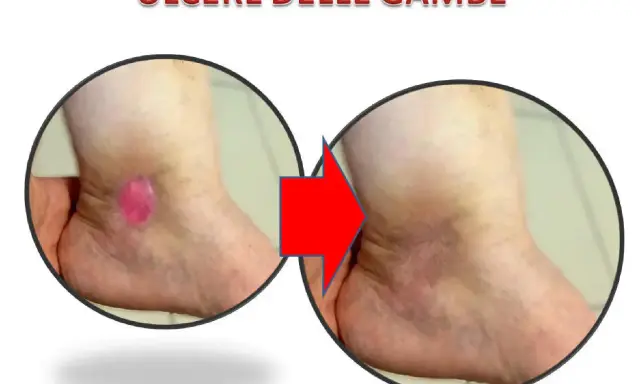 Prima e dopo: ulcere alle gambe che perdono acqua, ora in guarigione.