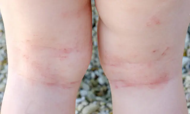 Gambe di bambino con arrossamenti e lievi macchie da sudore sulle ginocchia, forse dovuti al caldo estivo.