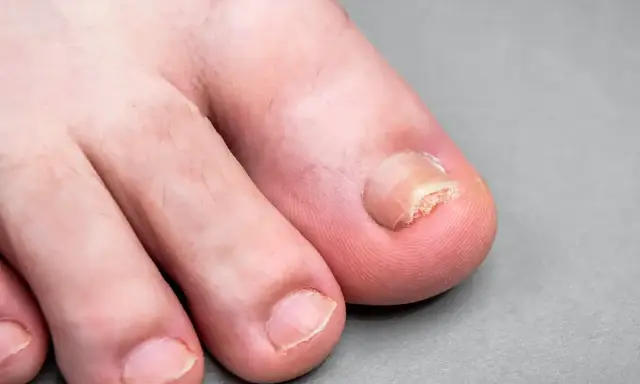 Unghia del piede affetta da onicogrifosi, ispessita e deformata. Scopri come curarla per ritrovare piedi sani.