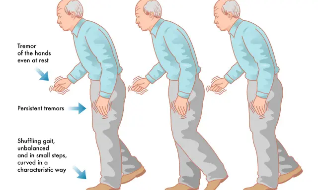 Uomo con tremori alle mani e andatura incerta, sintomi del parkinson. La difficoltà a parlare è un altro sintomo comune.
