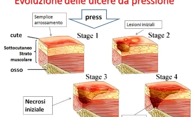 Evoluzione delle piaghe da decubito: da semplice arrossamento a necrosi profonda, mostrando le varie fasi di formazione.