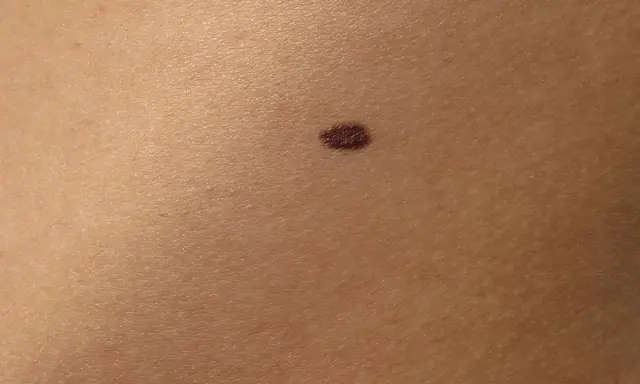 Un neo scuro sulla pelle, un piccolo punto che potrebbe nascondere insidie nei pericolosi.