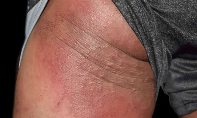 Arrossamento e piccole vescicole sulla pelle, indicative di dermatite sedere adulto.