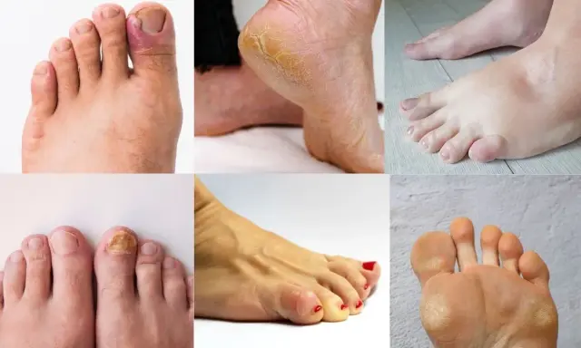 La podologia cos'è? Immagini di piedi con unghie incarnite, talloni screpolati, funghi, calli e gonfiore.