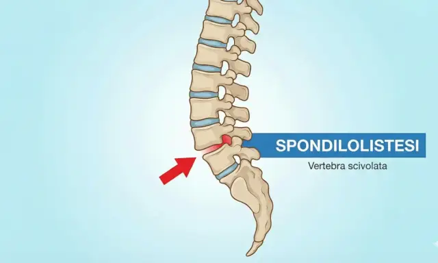 Illustrazione della spondilolistesi, con una vertebra lombare scivolata in avanti. Potrebbe causare sintomi neurologici.