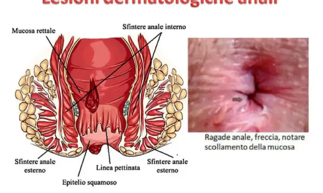 Illustrazione anatomica dell'ano e immagine di una ragade anale, che può causare dermatite perianale.