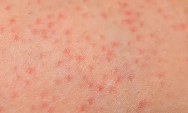 Pelle con prurito alle gambe, caratterizzata da numerosi puntini rossi che indicano un'irritazione cutanea.