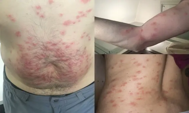 Punture di acaro su addome, braccio e schiena. Lesioni cutanee rosse e pruriginose diffuse.