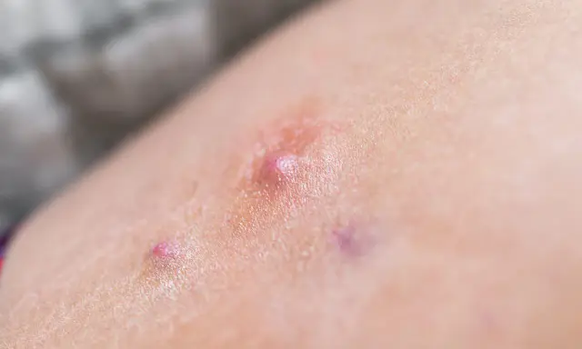 Pelle con arrossamento e piccole vescicole, indicative di dermatite bollosa.