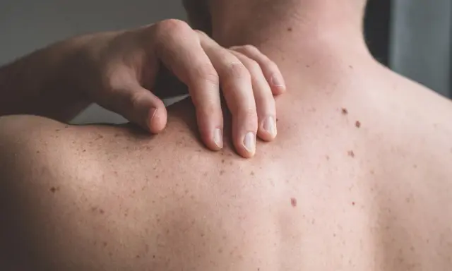 Una mano sfiora la schiena coperta di nei. Un neo irritato, forse dopo che ho grattato un neo ed è uscito sangue, attira l'attenzione.