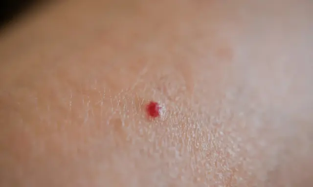 Piccola macchia rossa sulla pelle, un neo rubino che non prude.