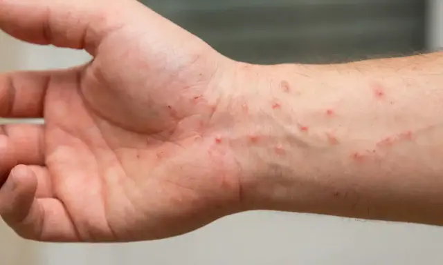 Pelle arrossata e irritata sul polso, con piccole pustole e graffi, sintomi di dermatiti da acaro.