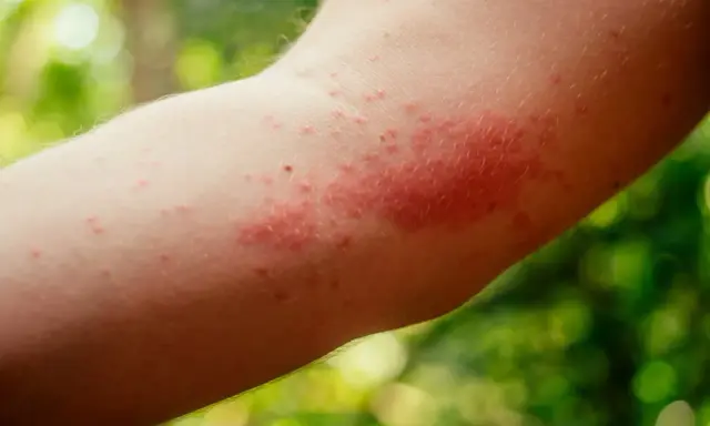 Arrossamento e piccoli pomfi sull'avambraccio: ecco come riconoscerla puntura ape.
