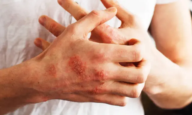 Mani con chiazze rosse e squamose, segno di psoriasi. Nonostante non sia mortale, la psoriasi può avere un impatto devastante sulla qualità della vita.
