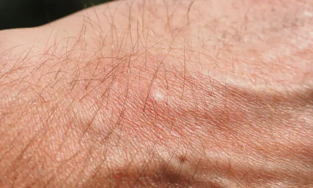 Pelle secca e arrossata con peli sottili, possibile prurito senile. Il trattamento per la xerosi cutanea è fondamentale.