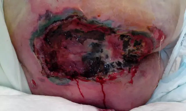 Grave lesione da decubito con tessuto necrotico e sanguinamento. La prevenzione piaghe da decubito è fondamentale per evitare queste condizioni.