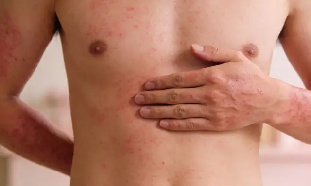 Torso e braccia di una persona con estese irritazioni cutanee rosse e pruriginose.