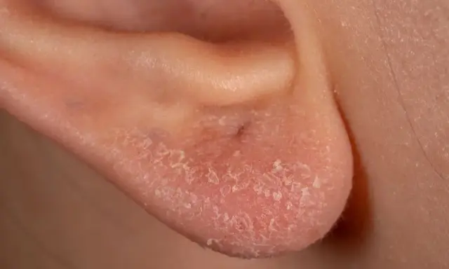 Orecchio con pelle arrossata e desquamata, sintomo di una possibile allergia al nichel.
