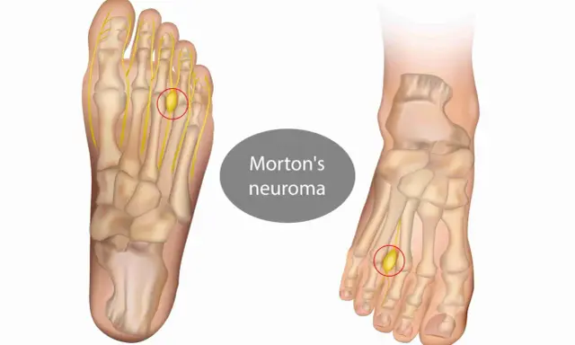 Illustrazione anatomica del piede che mostra un neuroma di Morton, una condizione che rende difficile camminare.