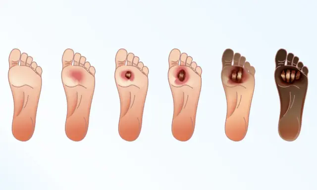 Progressione di ulcere al piede, dalla lieve infiammazione alla necrosi. Immagine illustra come disinfettare le ulcere alle gambe.