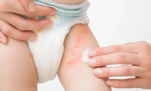 Mano applica crema su pelle arrossata di neonato, sintomo di ustione da pannolino.