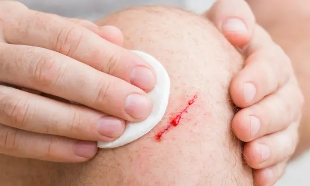 Mano che pulisce una ferita sanguinante sul ginocchio, segno di pelle che si lacera facilmente.