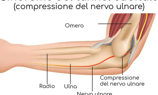 Illustrazione anatomica del gomito che mostra la compressione del nervo ulnare nel tunnel cubitale, con il nervo ulnare infiammato.