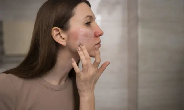 Donna applica crema su viso arrossato, cercando sollievo dalle piaghe della pelle.