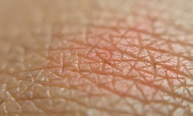 Close-up della pelle con arrossamento, suggerisce irritazione piega sedere rimedi.